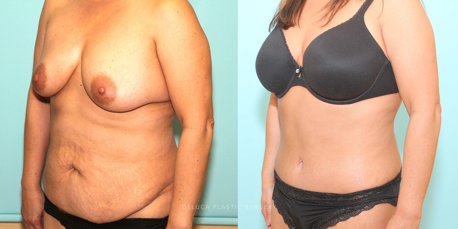 48 year old Tummy Tuck (Abdominoplasty)