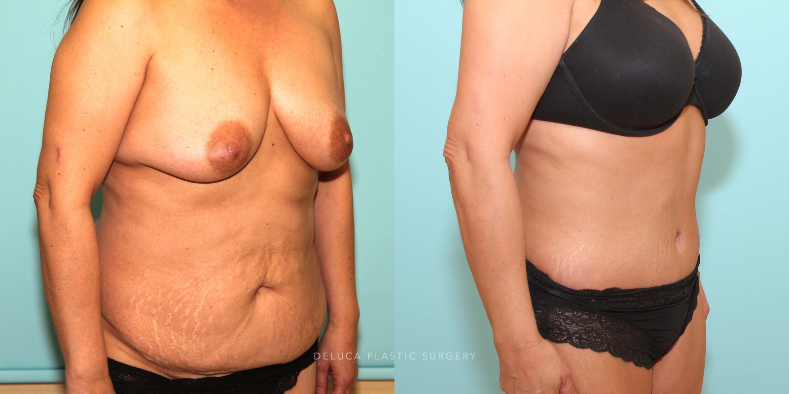 48 year old Tummy Tuck (Abdominoplasty)