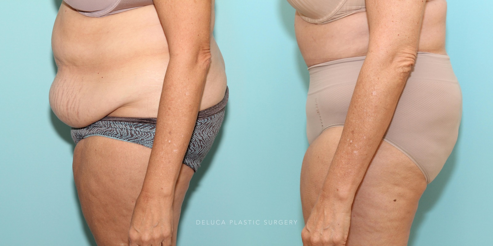 56 year old Tummy Tuck (Abdominoplasty)