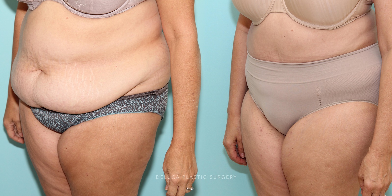 56 year old Tummy Tuck (Abdominoplasty)