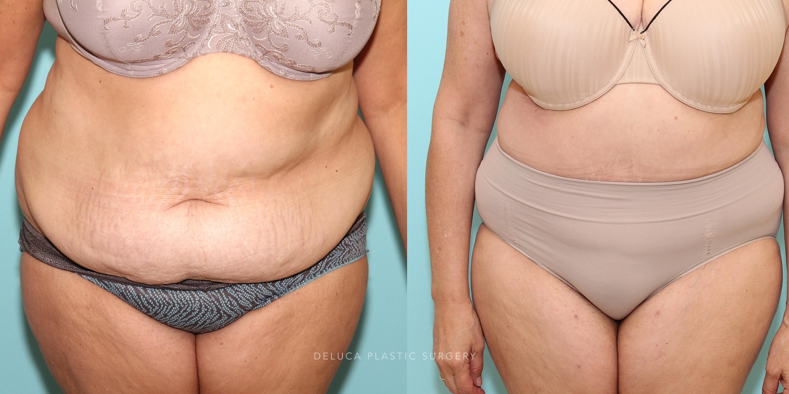 56 year old Tummy Tuck (Abdominoplasty)