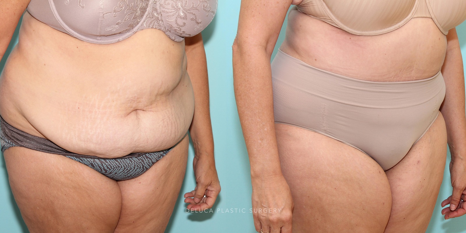 56 year old Tummy Tuck (Abdominoplasty)