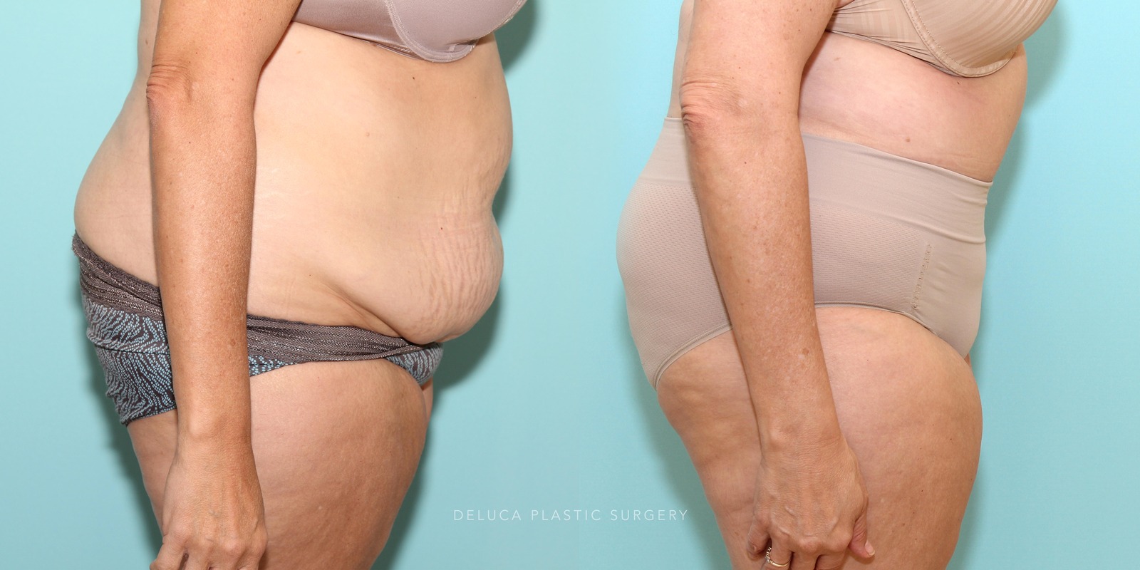 56 year old Tummy Tuck (Abdominoplasty)