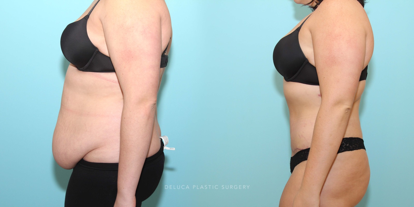 21 year old Tummy Tuck (Abdominoplasty)