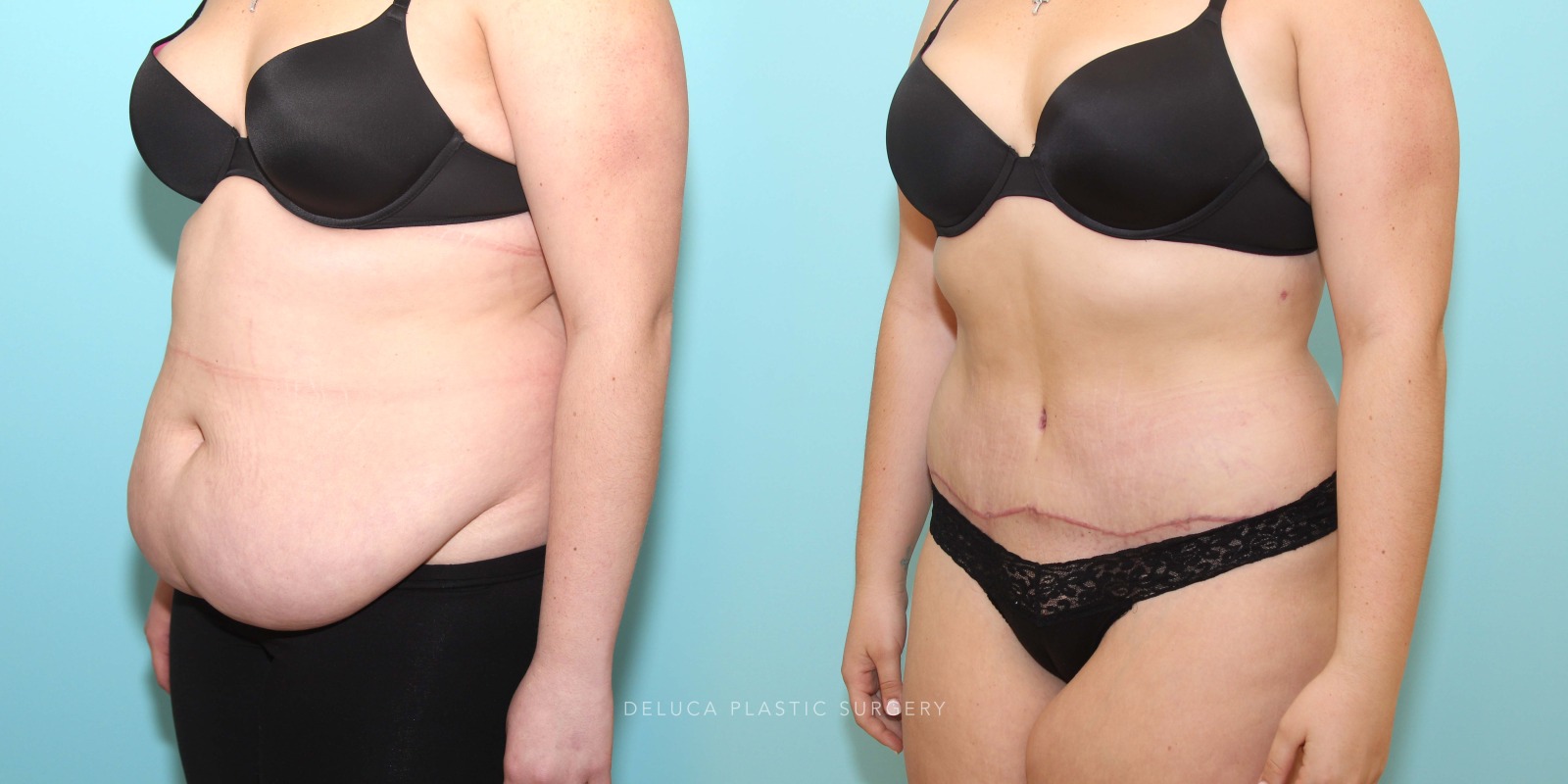 21 year old Tummy Tuck (Abdominoplasty)