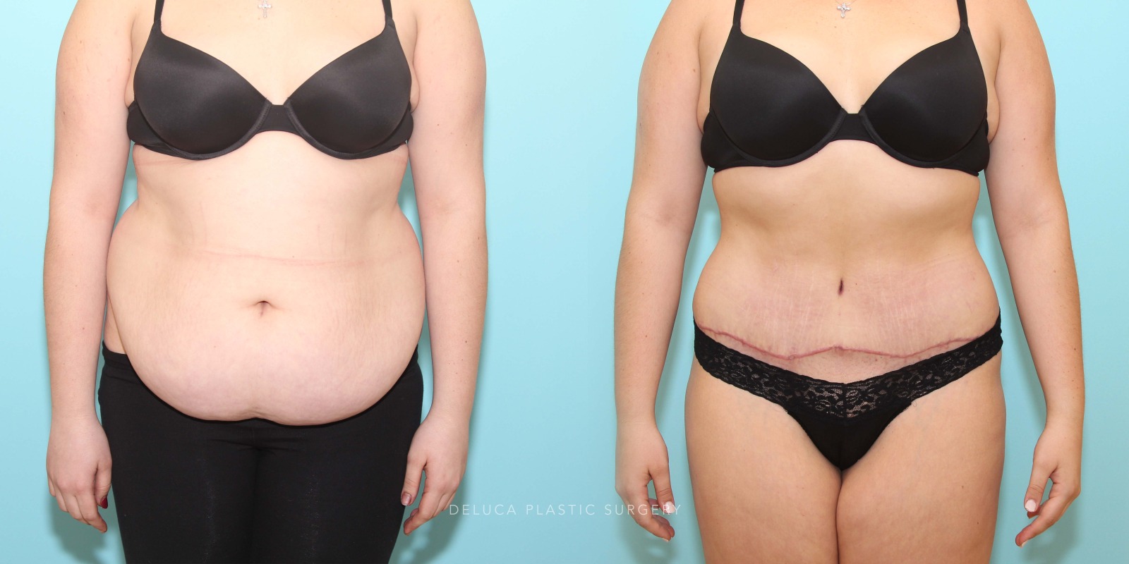 21 year old Tummy Tuck (Abdominoplasty)