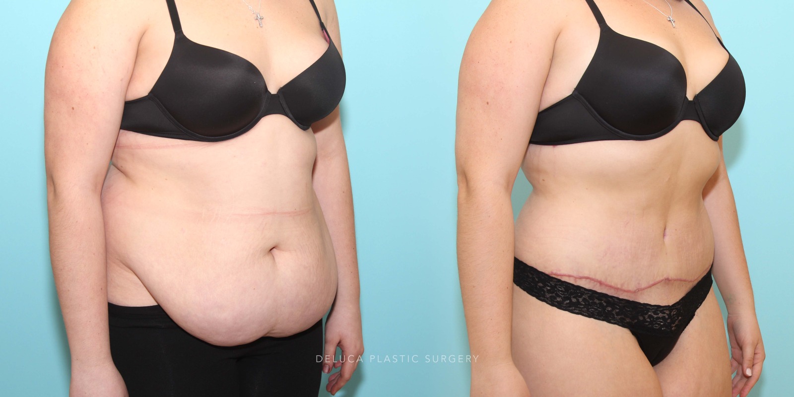 21 year old Tummy Tuck (Abdominoplasty)