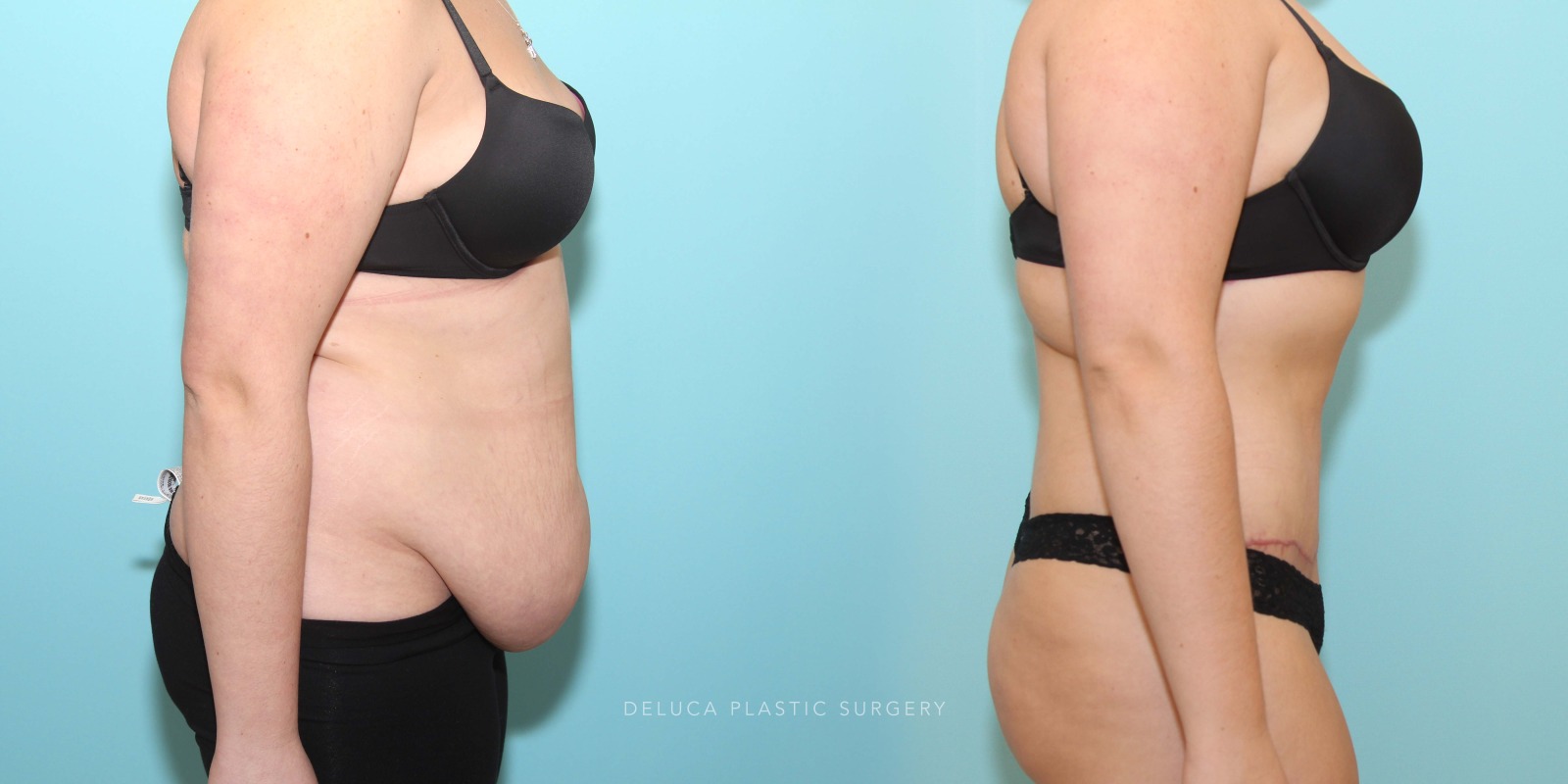 21 year old Tummy Tuck (Abdominoplasty)
