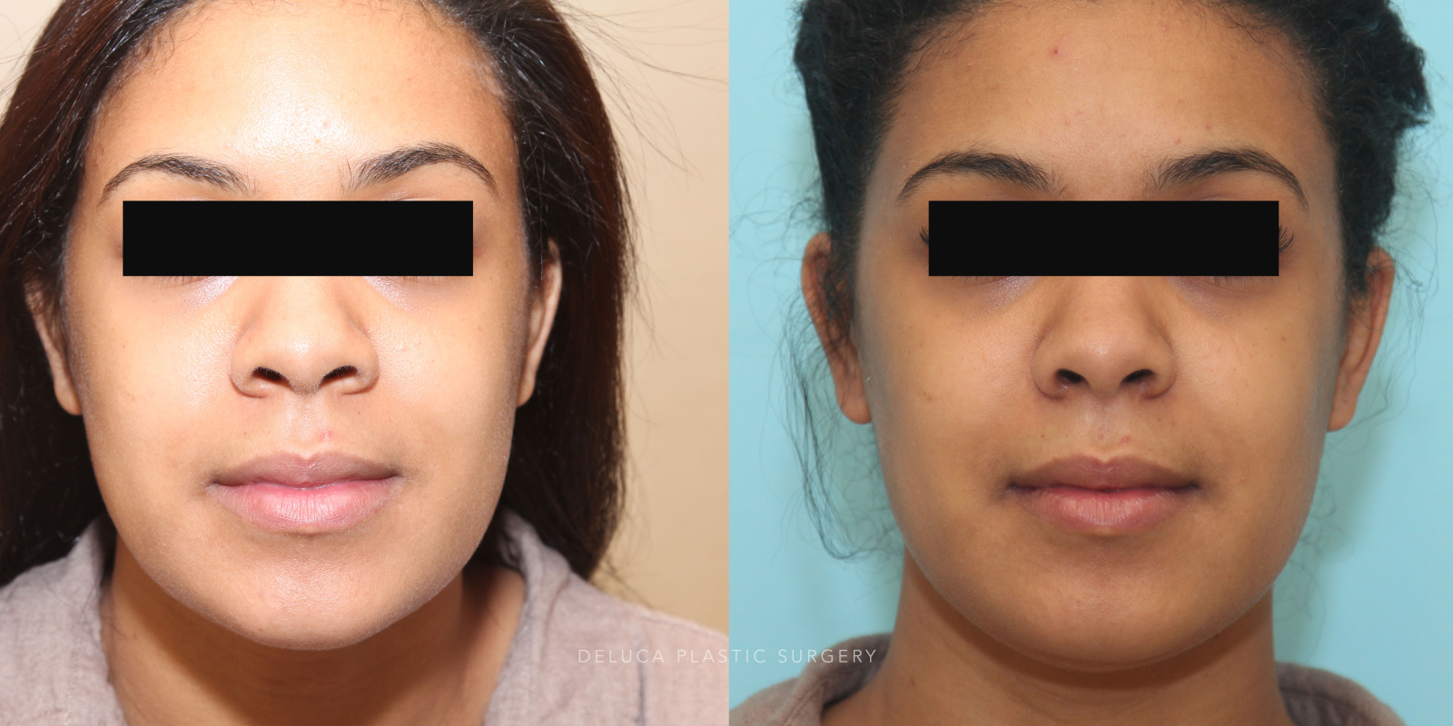 Unknown 0039 22 year old Alar Base Reduction
