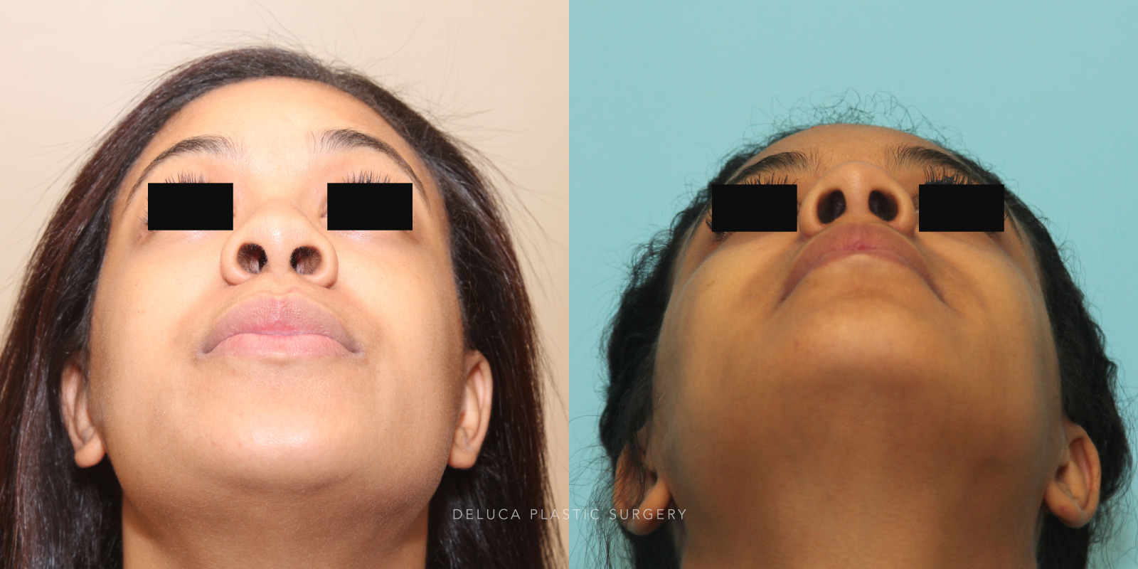 Unknown 0039 22 year old Alar Base Reduction