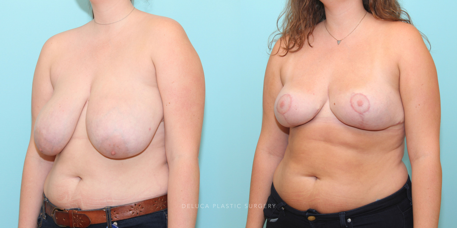 24 year old Inferior Pedicle, Wise Pattern Breast Reduction