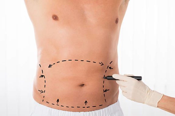 a closeup of a male patient preparing for a body procedure like tummy tuck or liposuction