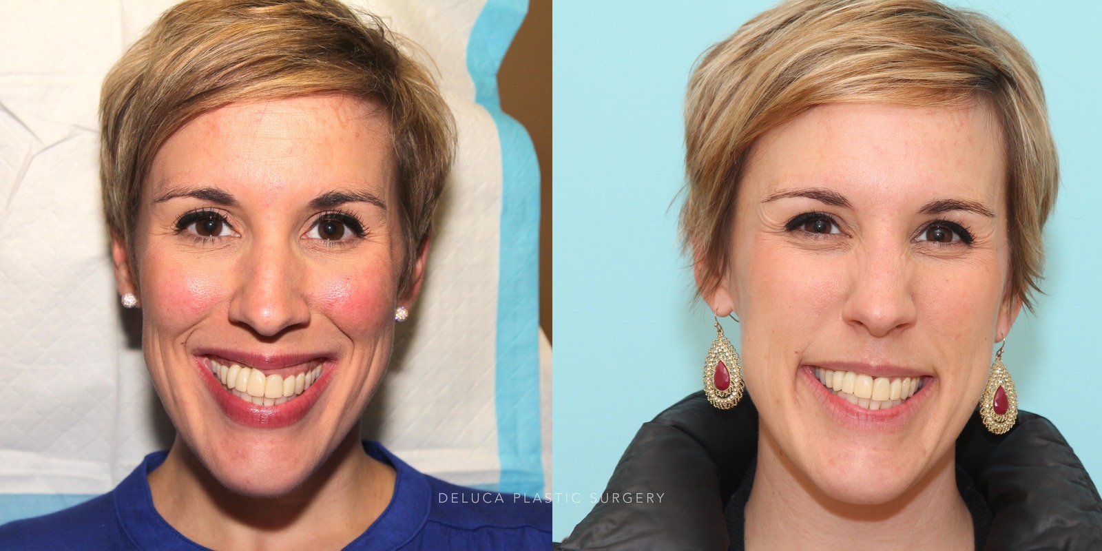 35 year old Botox Correction of A Gummy Smile