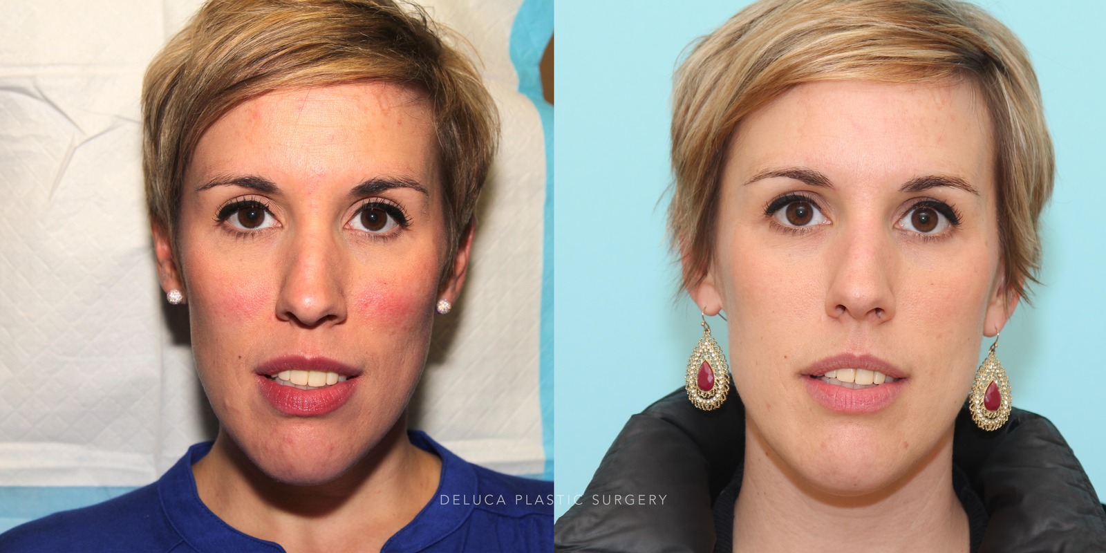 35 year old Botox Correction of A Gummy Smile