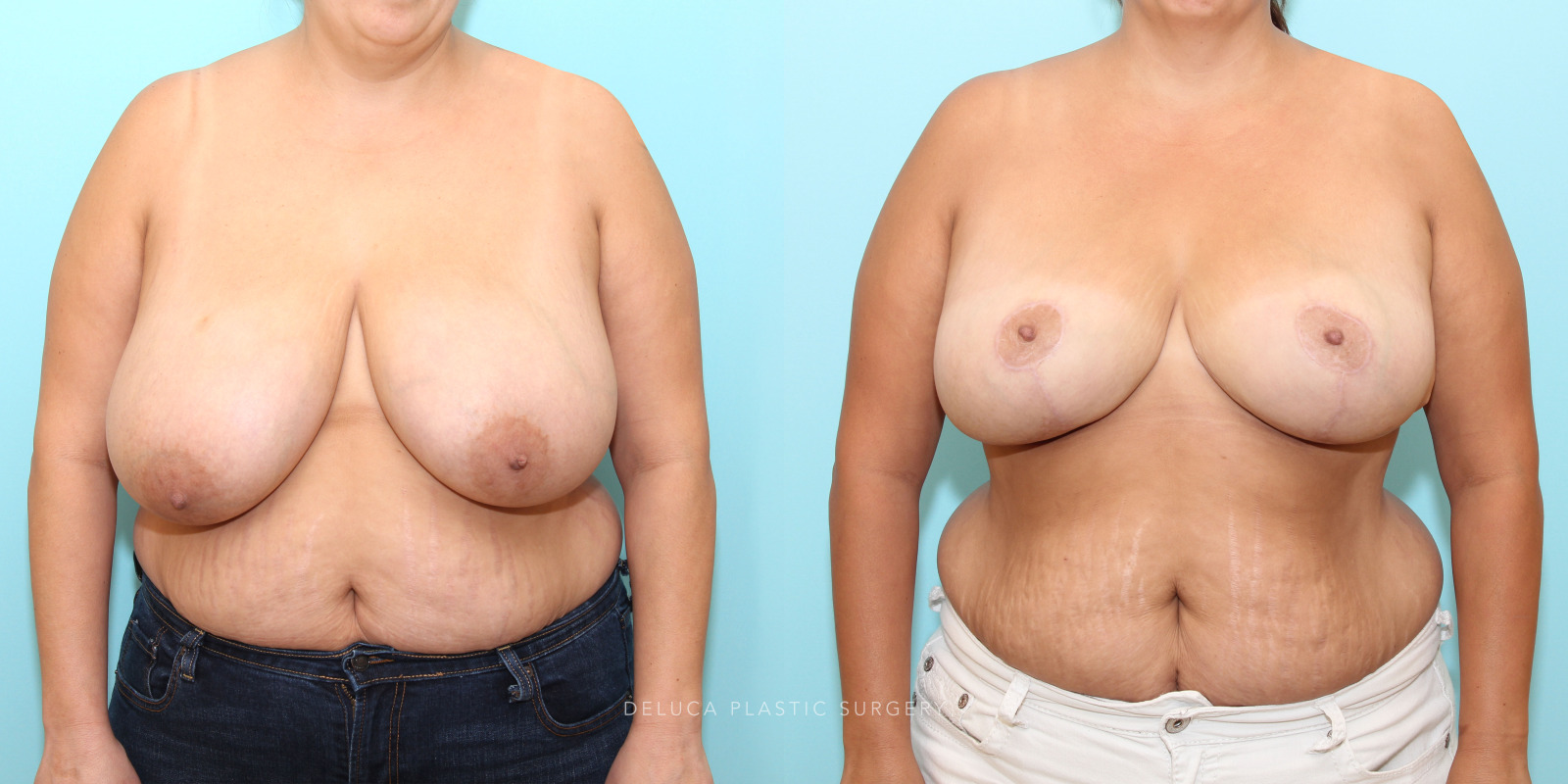 Unknown 0044 38 year old Inferior Pedicle, Wise Pattern Breast Reduction