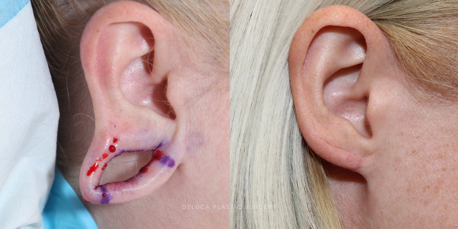 37 year old Closure of Gauge Earring Holes