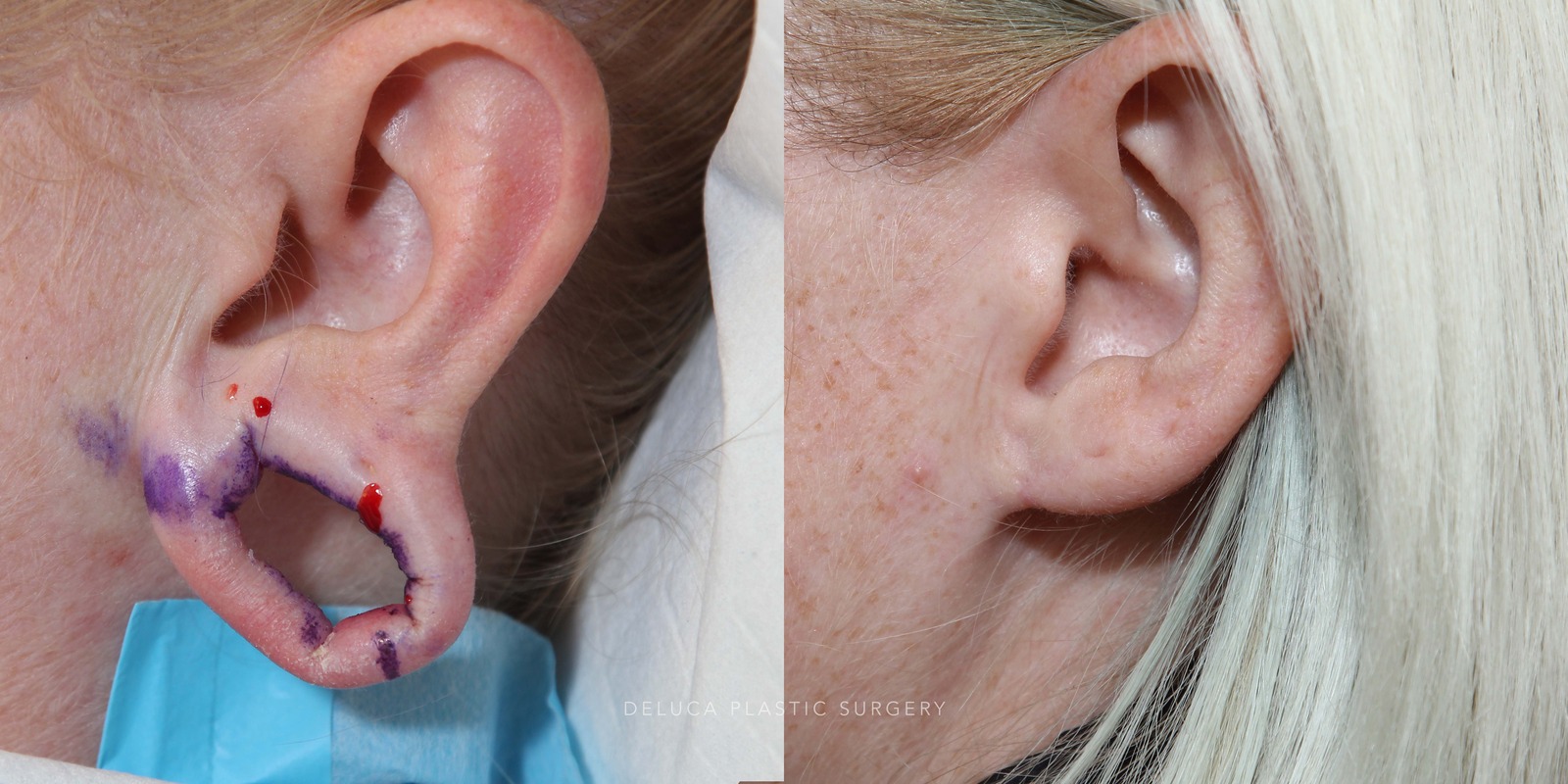 37 year old Closure of Gauge Earring Holes