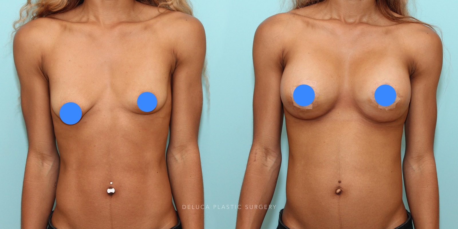 Tuberous breast correction before and after showing improved breast shape, areola contour, and symmetry