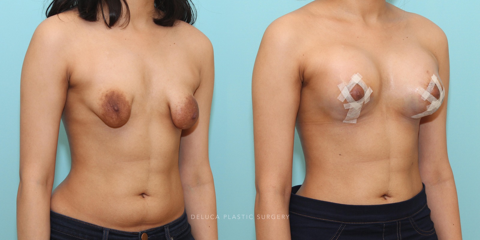 Correction of server tuberous breast deformity in a 22 year old young woman