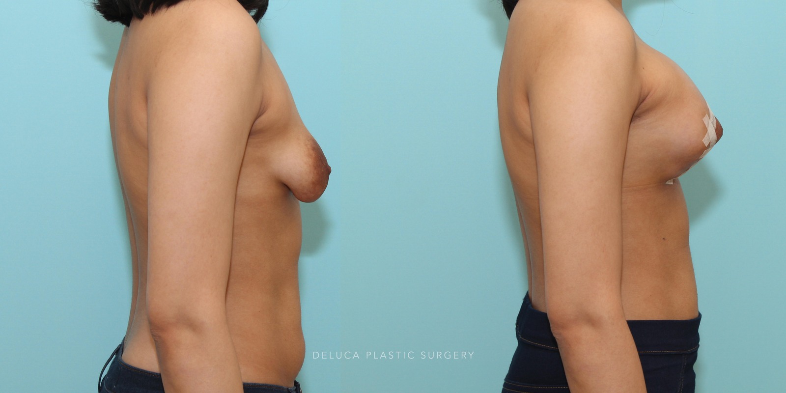 Correction of server tuberous breast deformity in a 22 year old young woman
