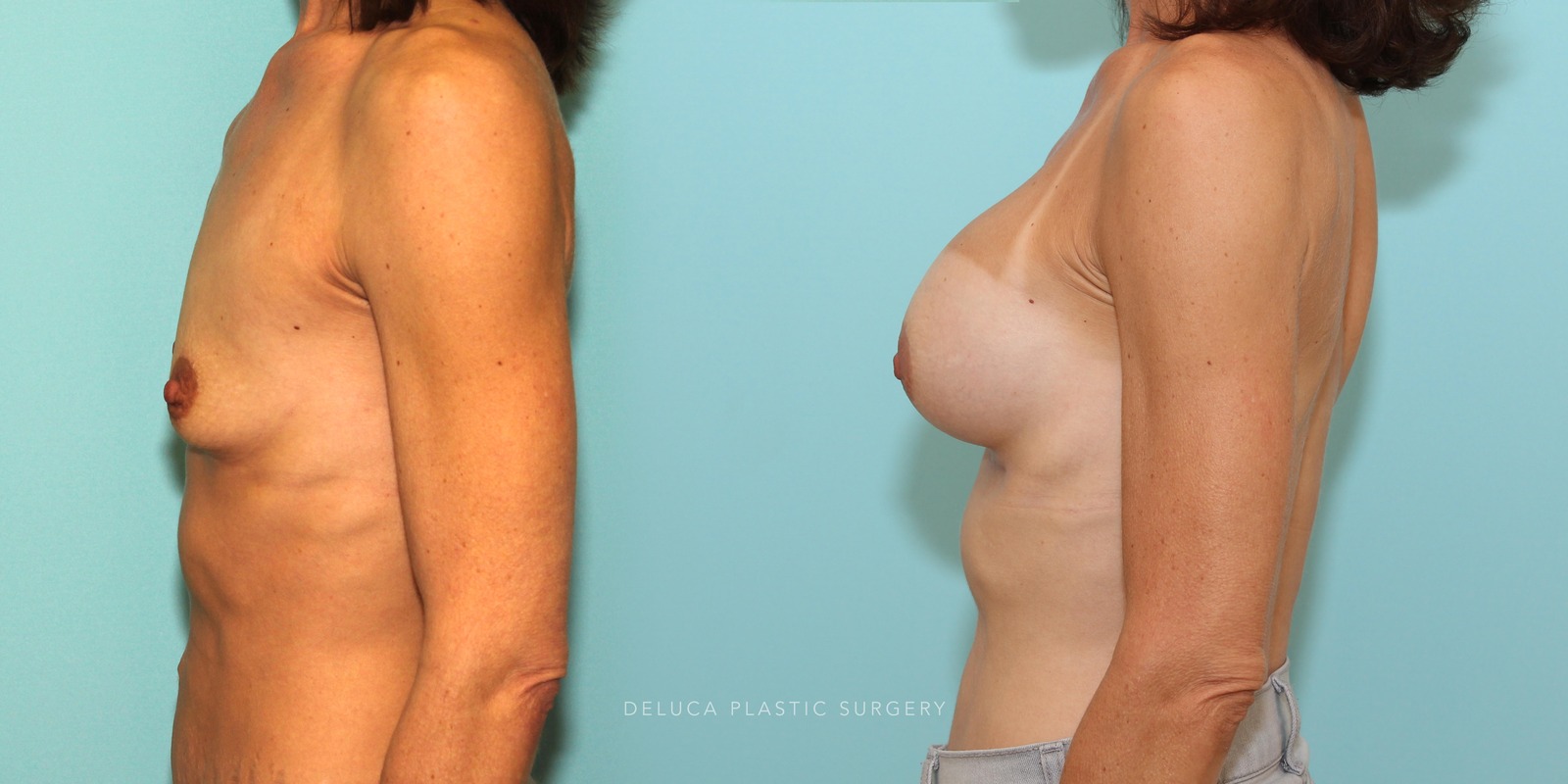 44 year old Dual Plane Asymmetric Breast Augmentation with 375ml High Profile Silicone Implants