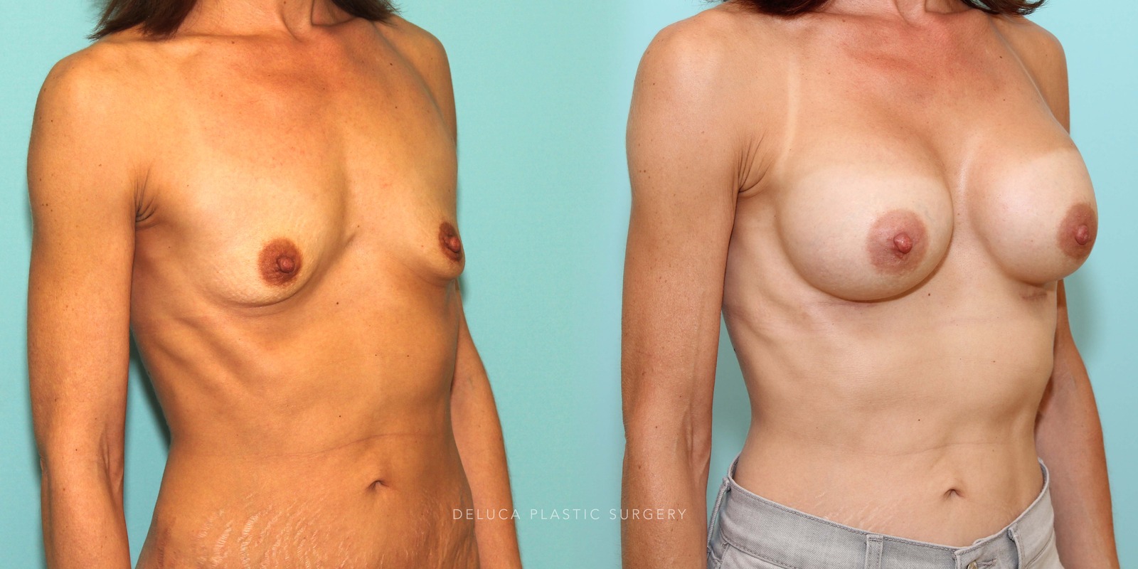 44 year old Dual Plane Asymmetric Breast Augmentation with 375ml High Profile Silicone Implants