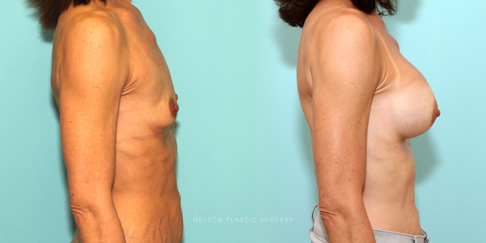 44 year old Dual Plane Asymmetric Breast Augmentation with 375ml High Profile Silicone Implants