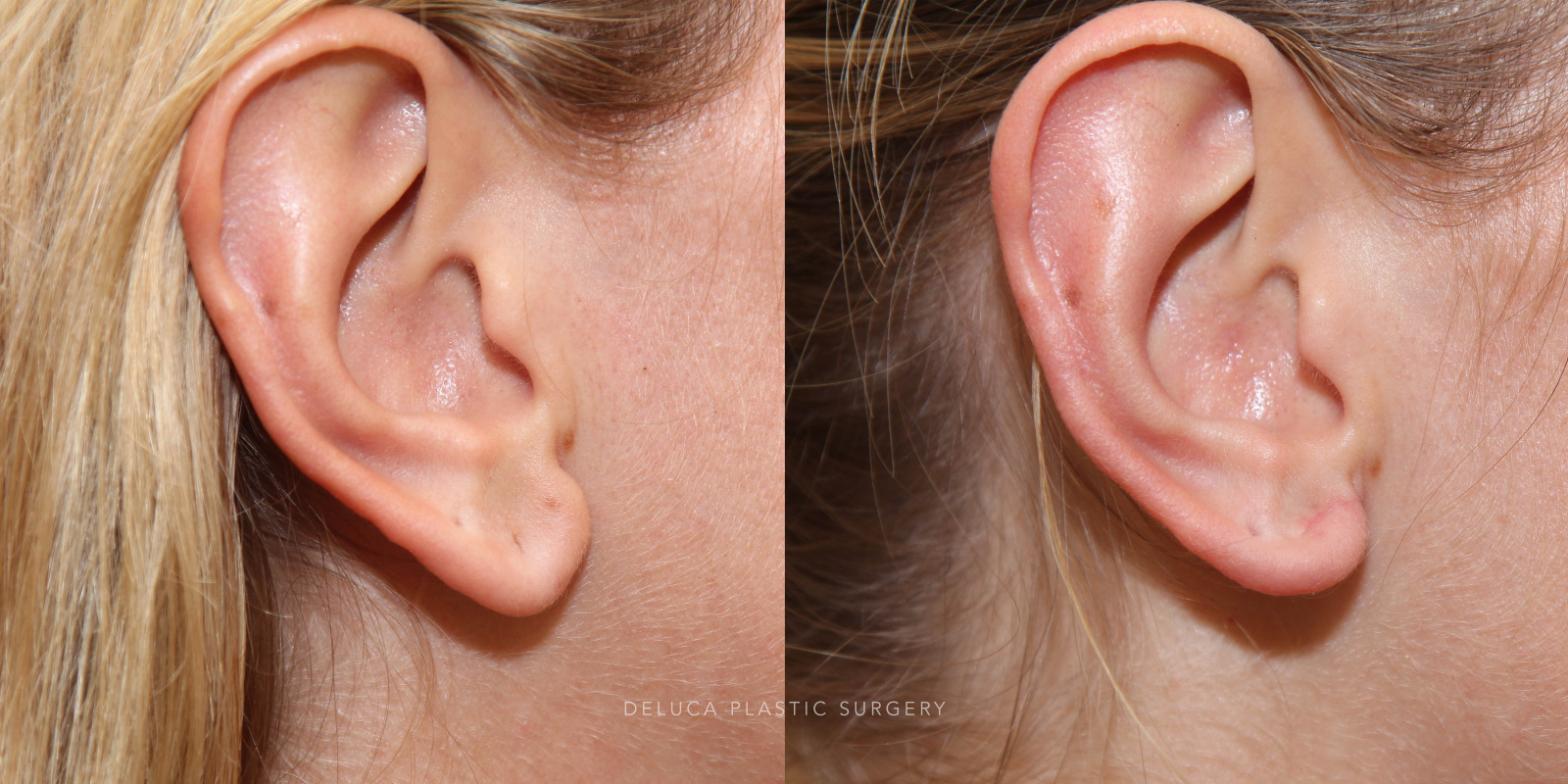 28 year old Earlobe Reduction