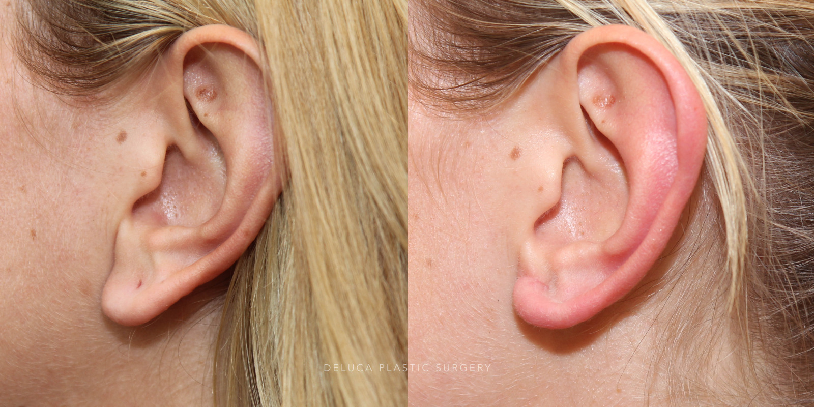 28 year old Earlobe Reduction