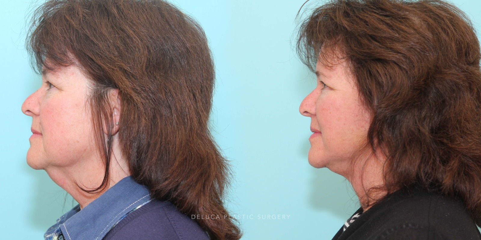 57 year old Face and Neck Lift and Upper and Lower Eyelid Blepharoplasty
