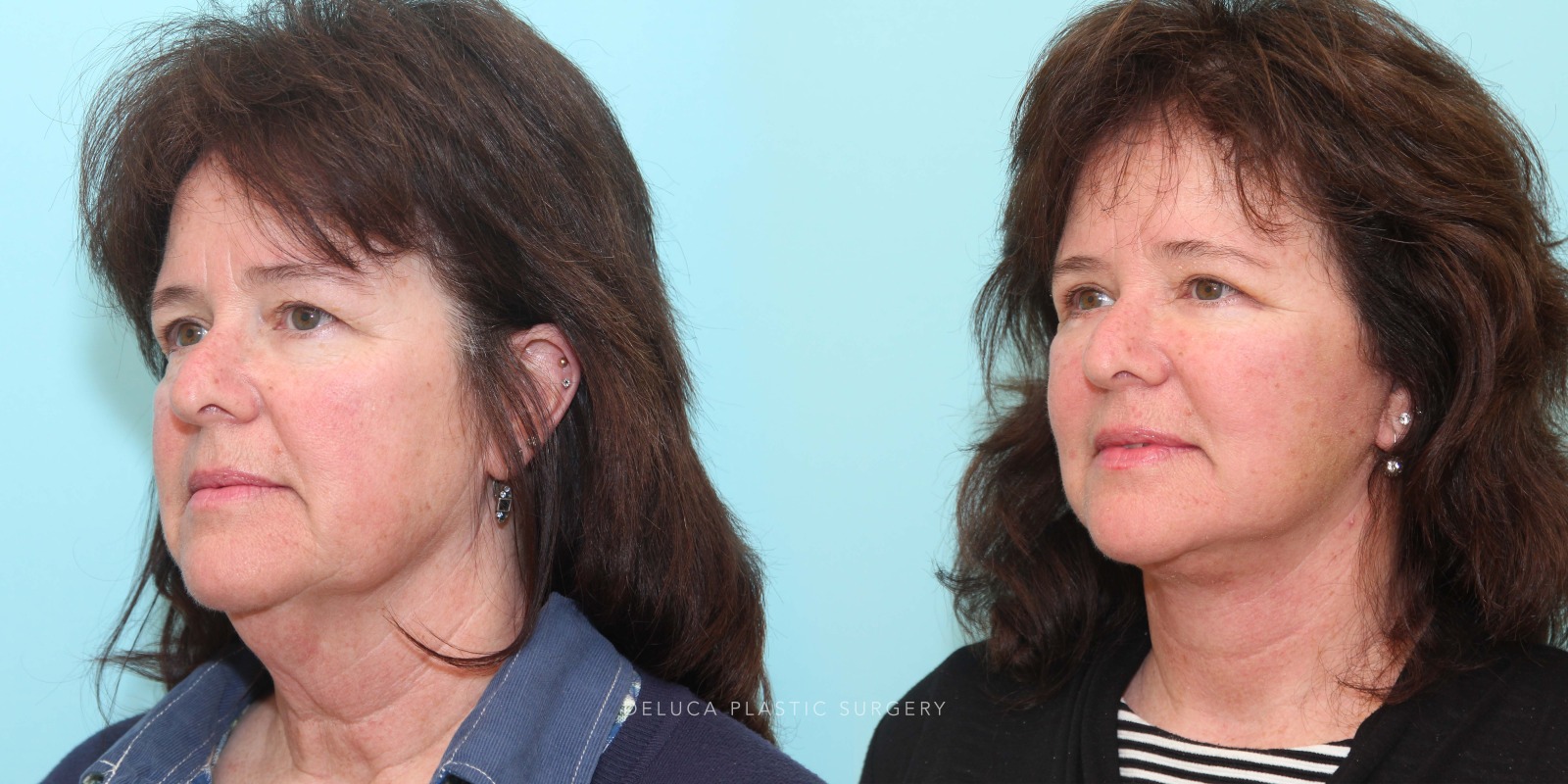 57 year old Face and Neck Lift and Upper and Lower Eyelid Blepharoplasty
