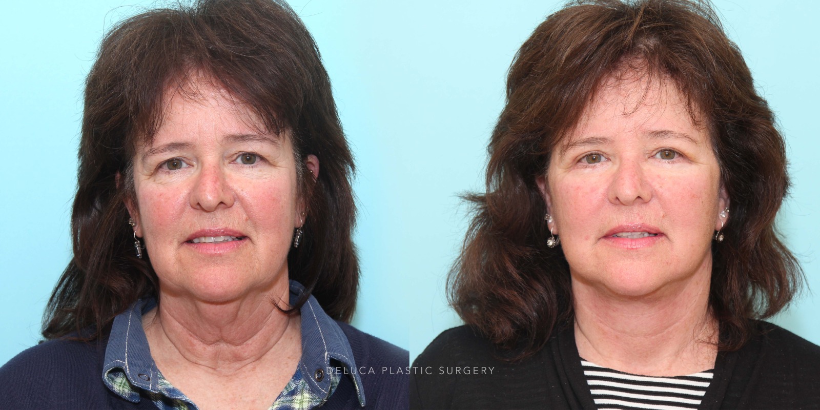 57 year old Face and Neck Lift and Upper and Lower Eyelid Blepharoplasty
