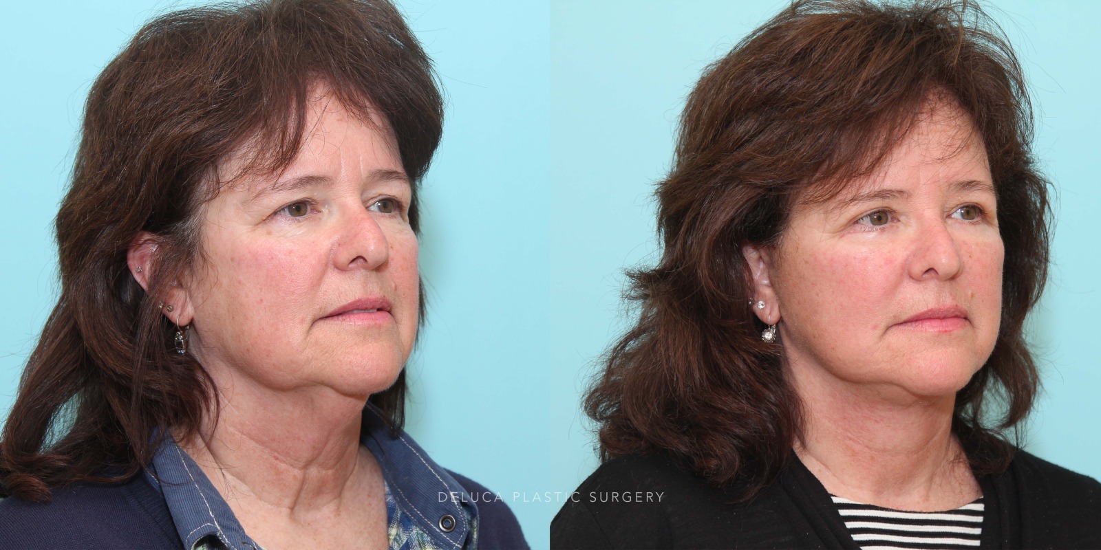57 year old Face and Neck Lift and Upper and Lower Eyelid Blepharoplasty