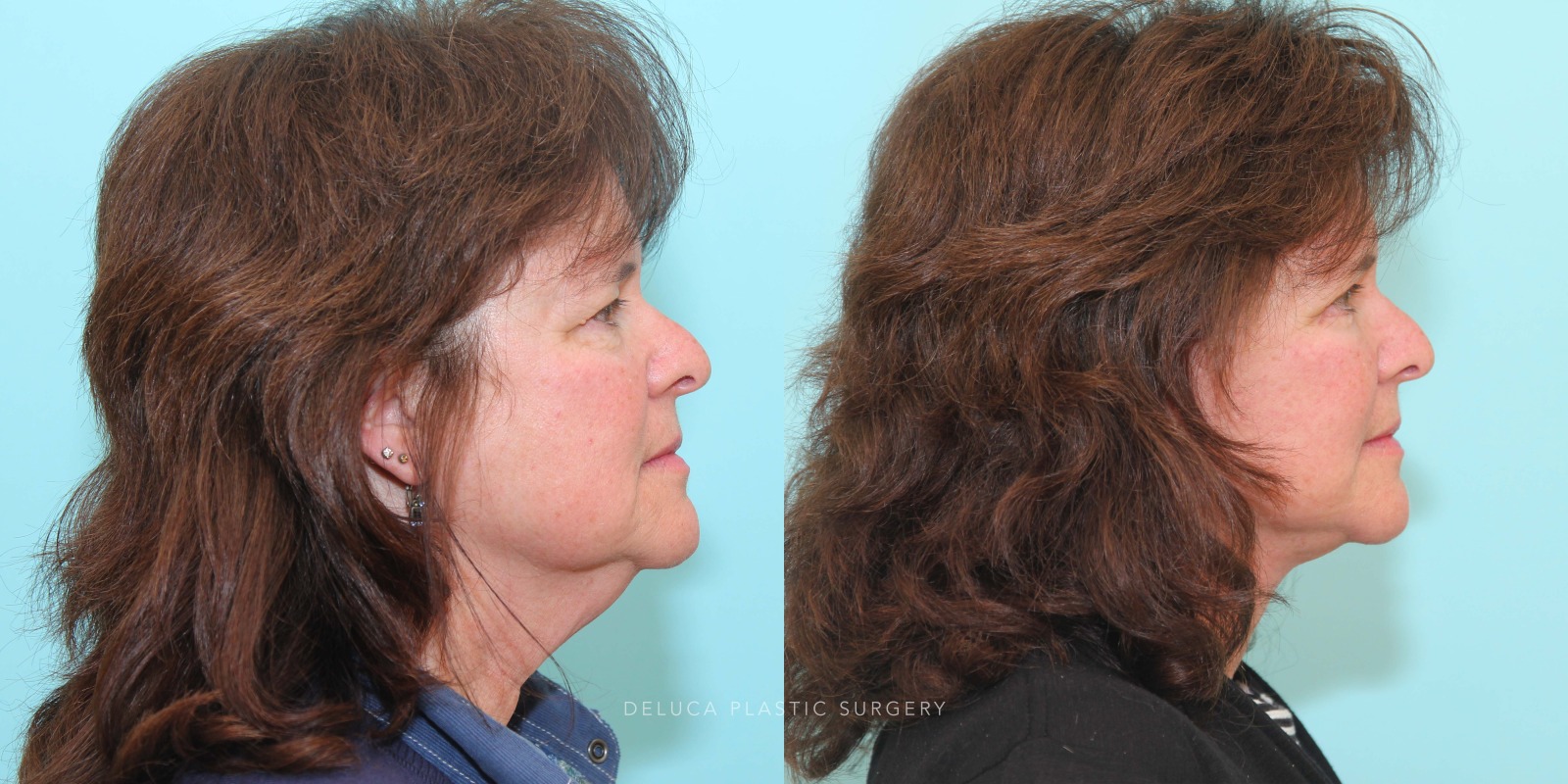 57 year old Face and Neck Lift and Upper and Lower Eyelid Blepharoplasty