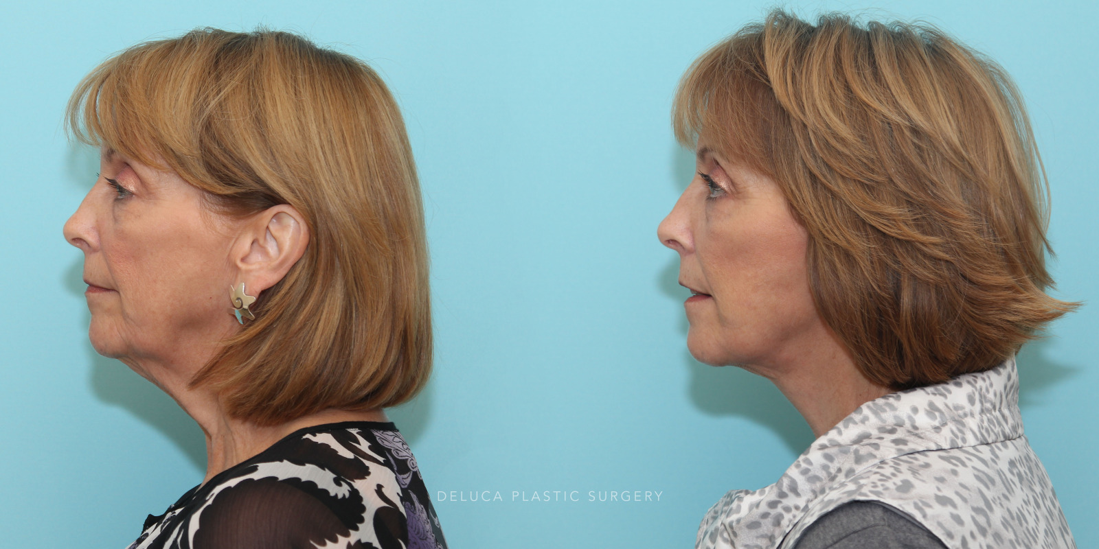 59 year old Face and Neck Lift and Lower Eyelid Blepharoplasty (Eyelid Lift)