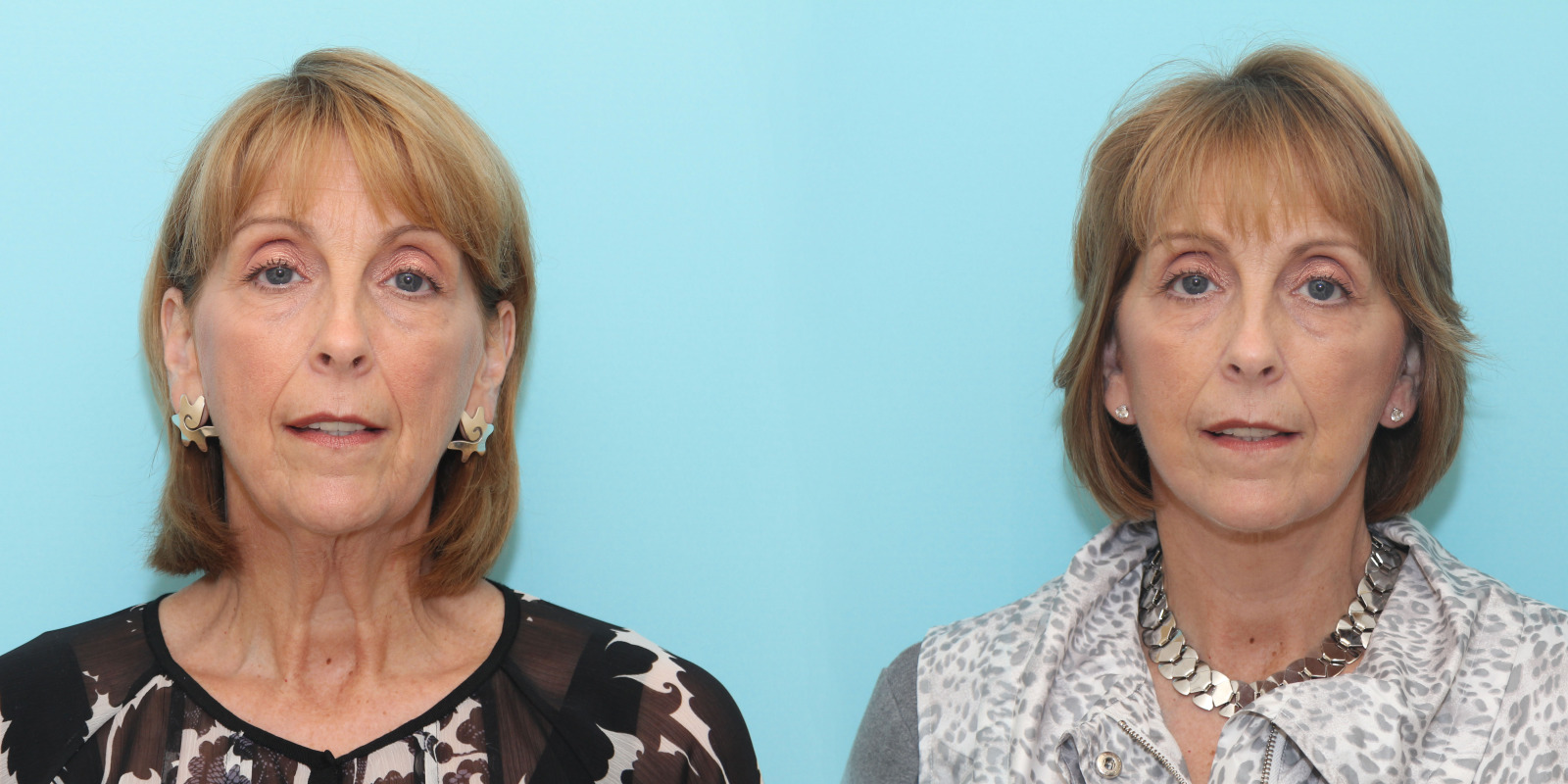 59 year old Face and Neck Lift and Lower Eyelid Blepharoplasty (Eyelid Lift)