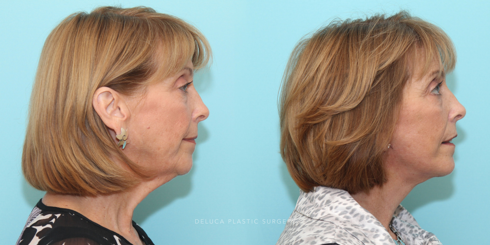 59 year old Face and Neck Lift and Lower Eyelid Blepharoplasty (Eyelid Lift)