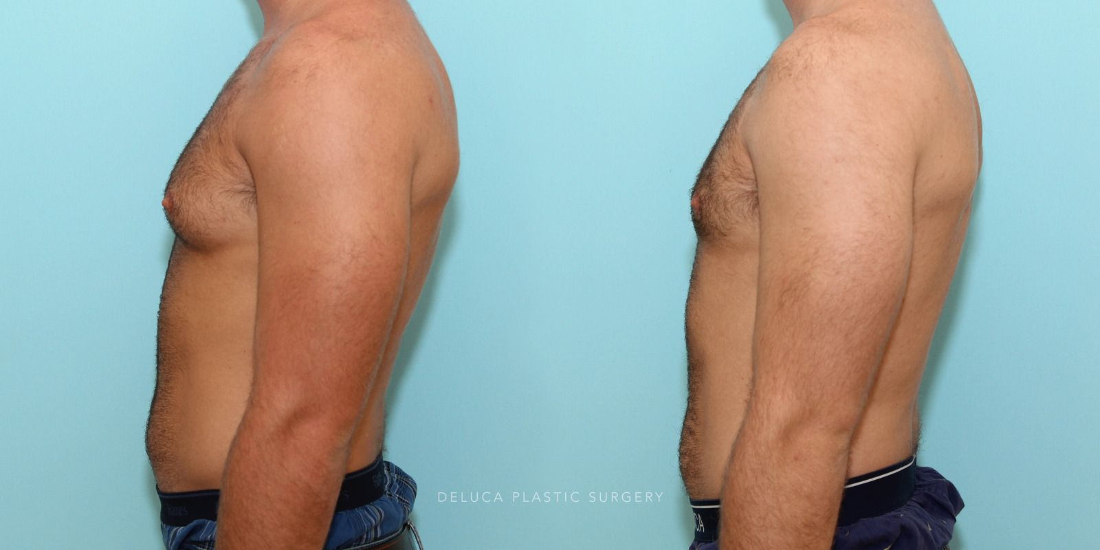 21 year old Correction of Gynecomastia Using Liposuction and Subcutaneous Mastectomy