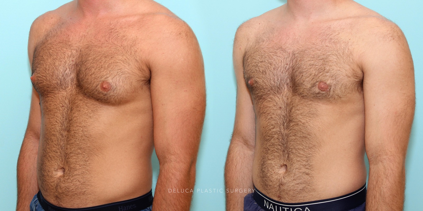 21 year old Correction of Gynecomastia Using Liposuction and Subcutaneous Mastectomy