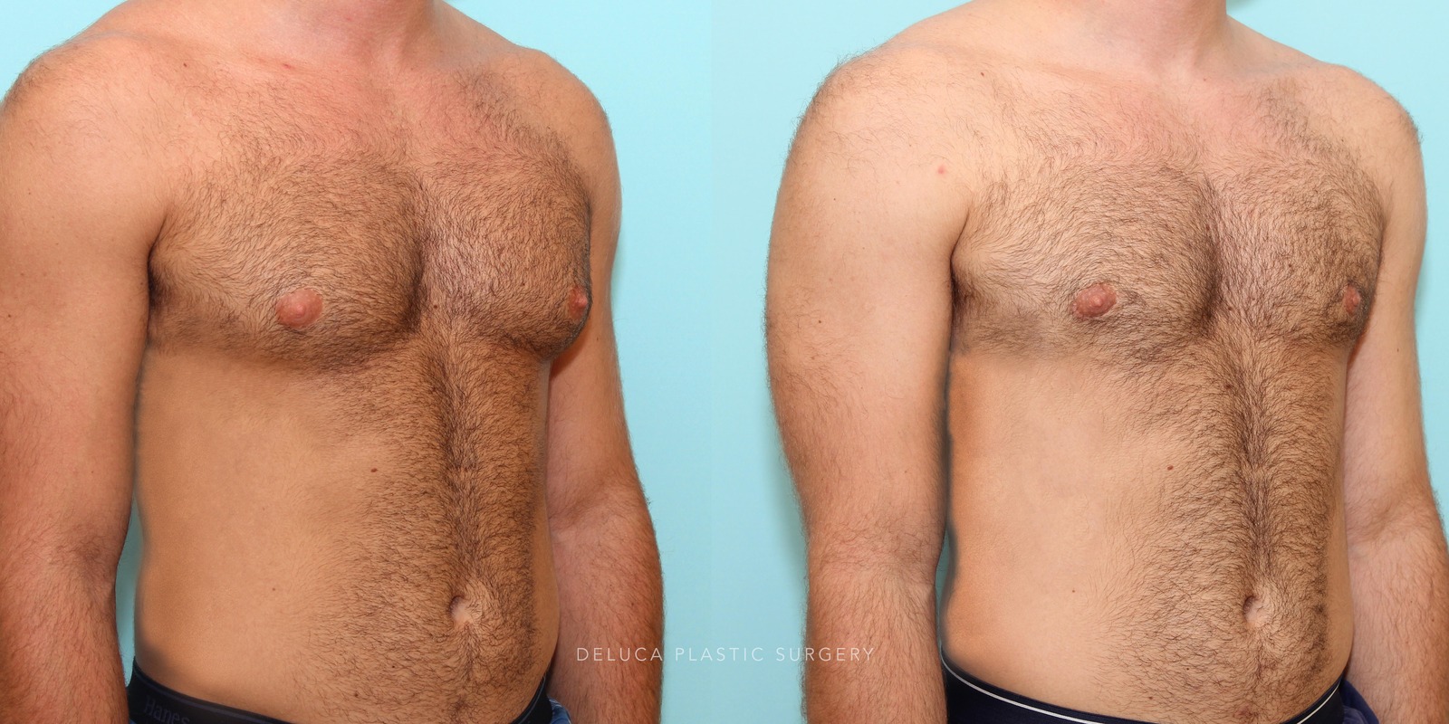 21 year old Correction of Gynecomastia Using Liposuction and Subcutaneous Mastectomy