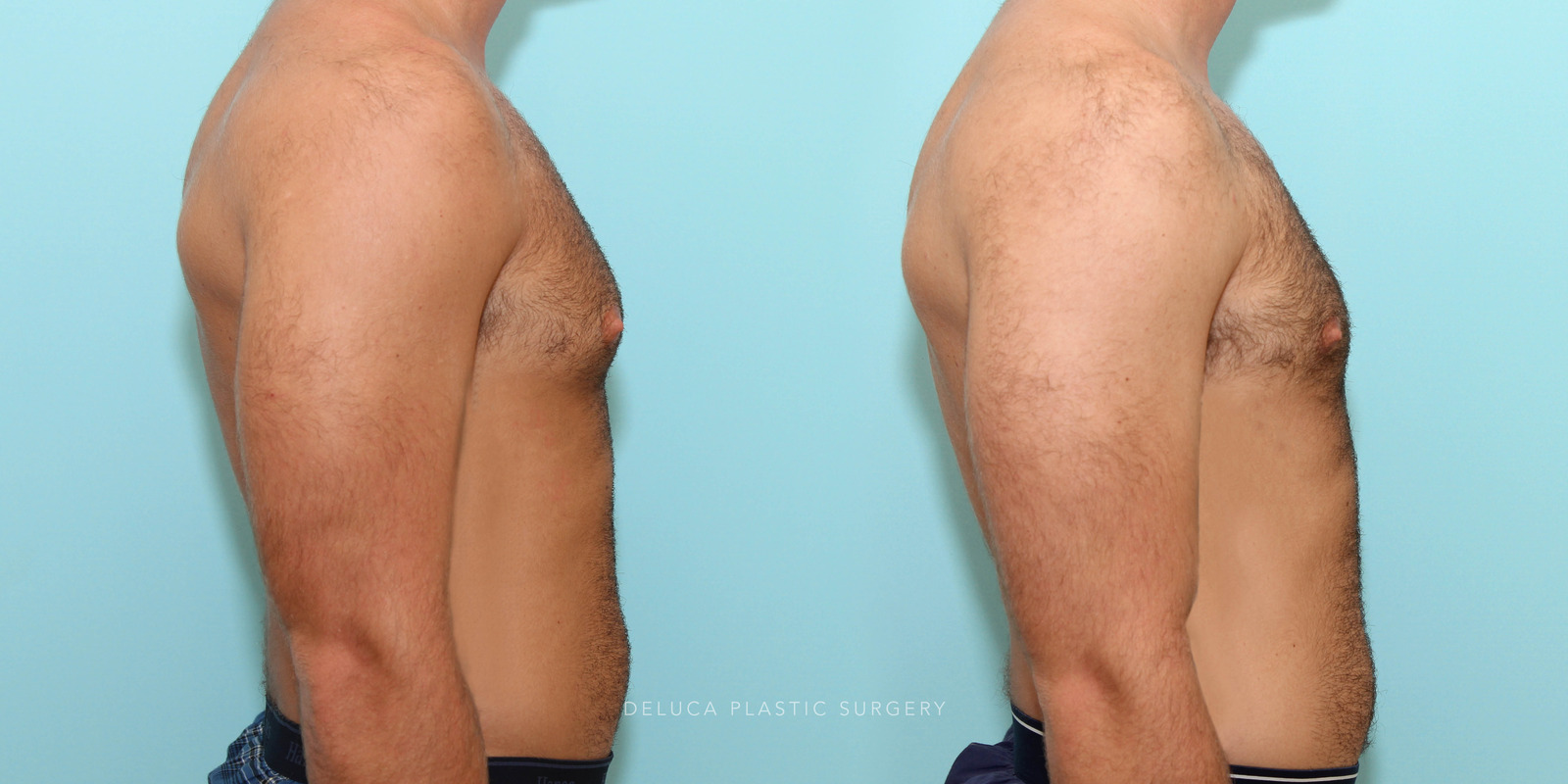21 year old Correction of Gynecomastia Using Liposuction and Subcutaneous Mastectomy