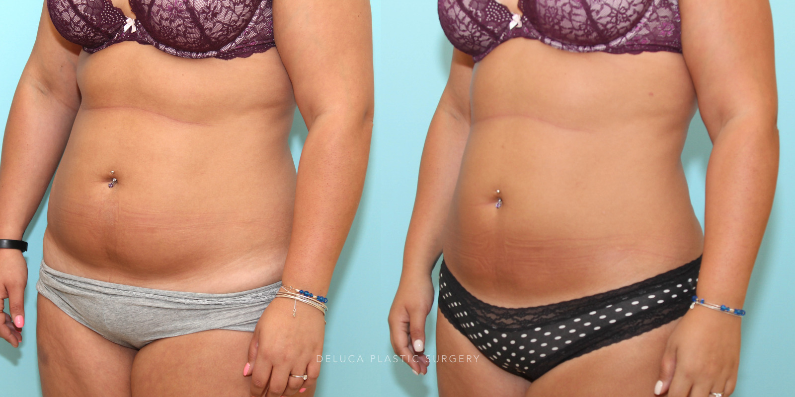 26 year old Liposuction of The Abdomen