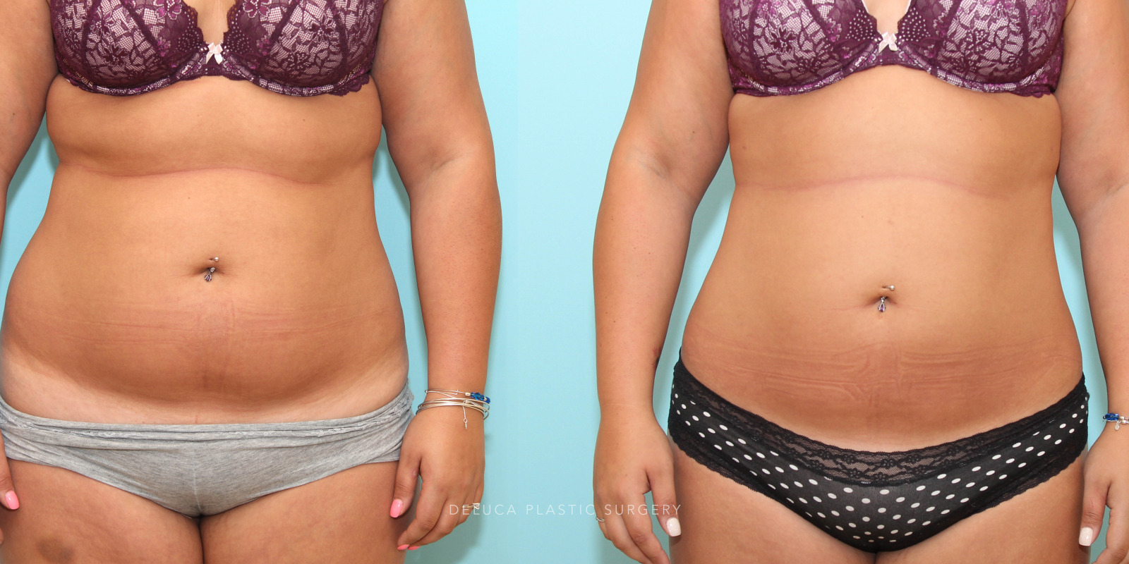 26 year old Liposuction of The Abdomen