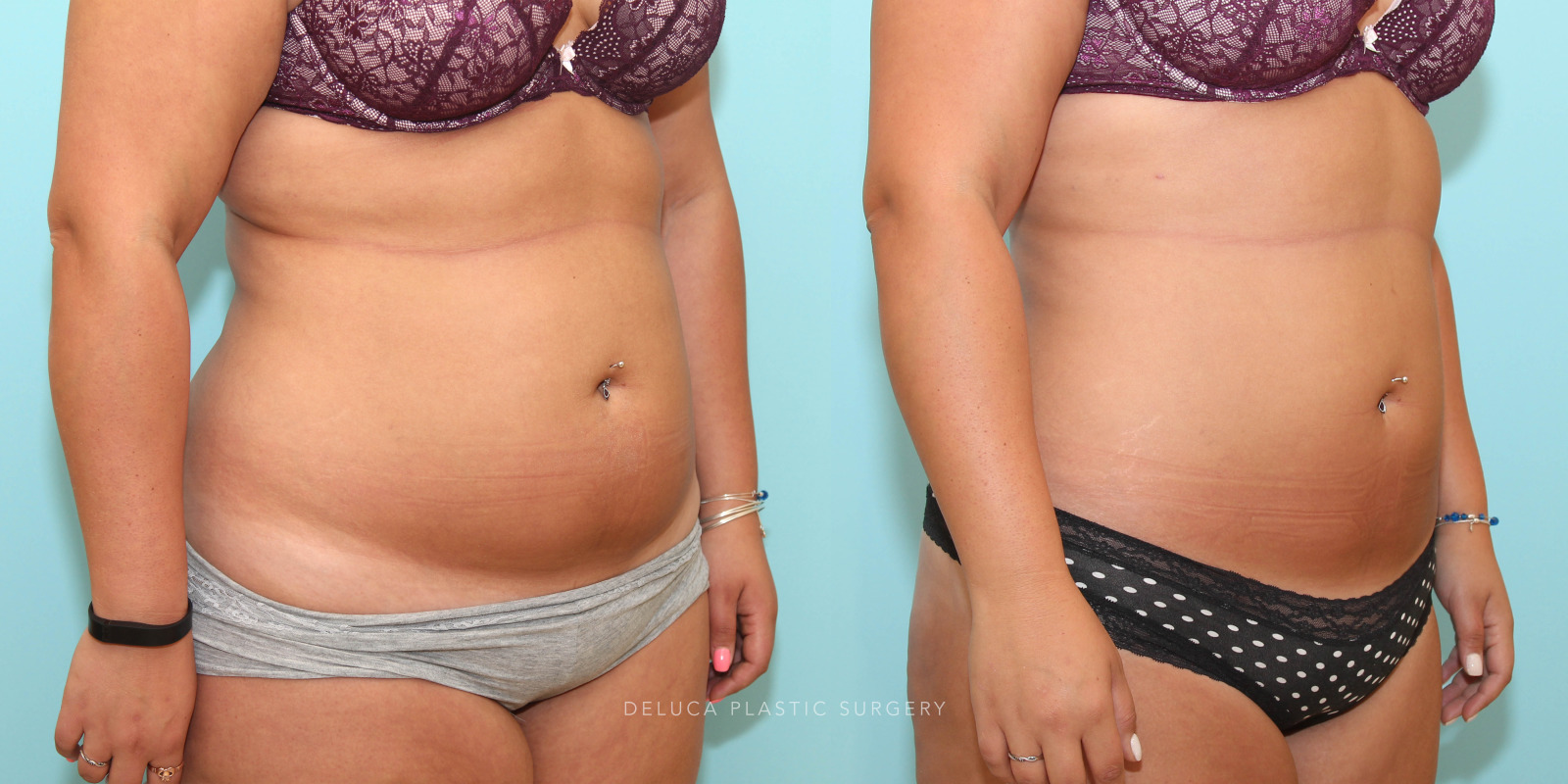 26 year old Liposuction of The Abdomen