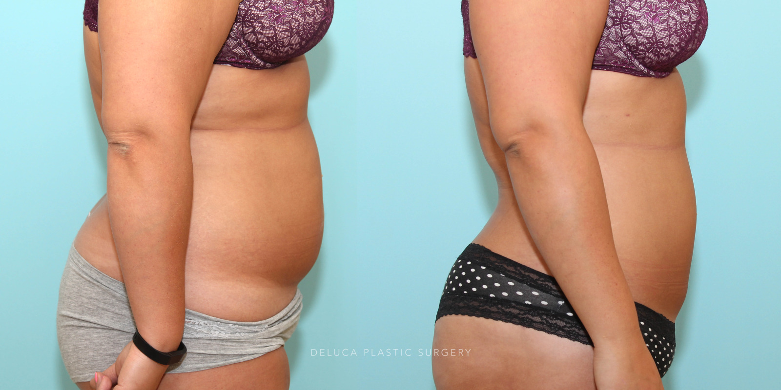 26 year old Liposuction of The Abdomen