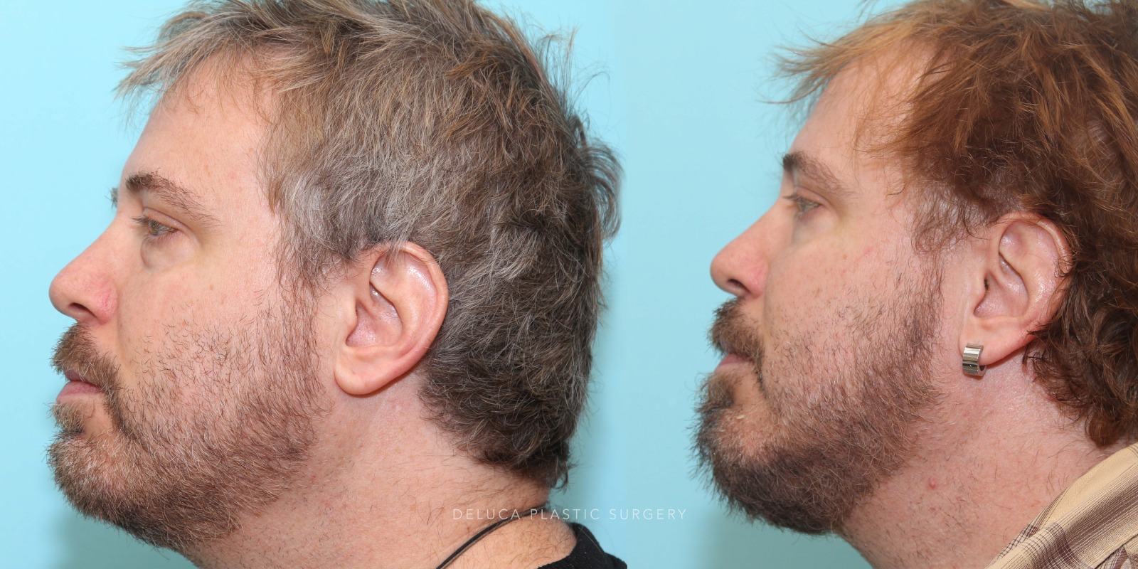 51 year old Lower Eyelid Blepharoplasty with Fat Redraping