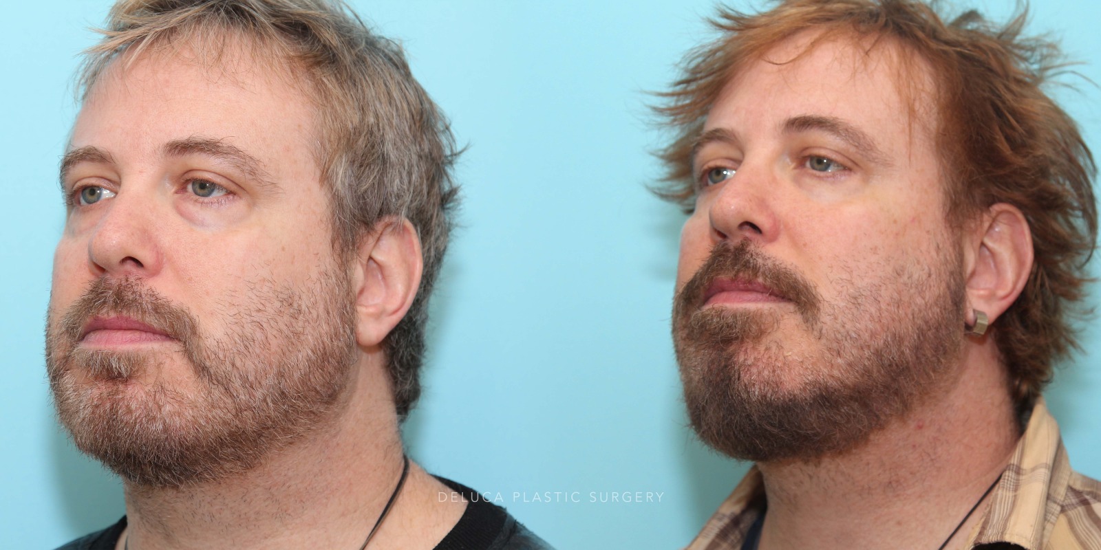 51 year old Lower Eyelid Blepharoplasty with Fat Redraping