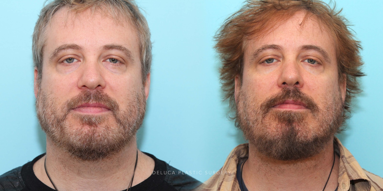 51 year old Lower Eyelid Blepharoplasty with Fat Redraping