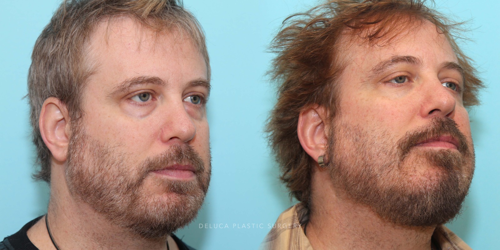 51 year old Lower Eyelid Blepharoplasty with Fat Redraping