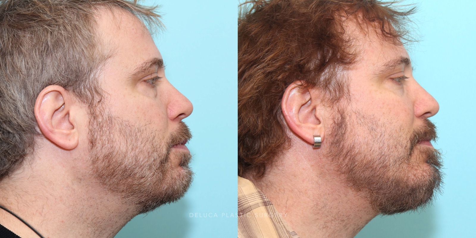 51 year old Lower Eyelid Blepharoplasty with Fat Redraping